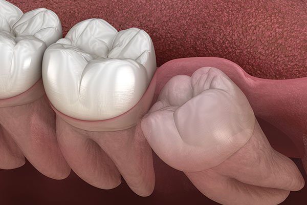 ޡA٬OޡHjv Wisdom Teeth: Should They Stay or Should They Go?